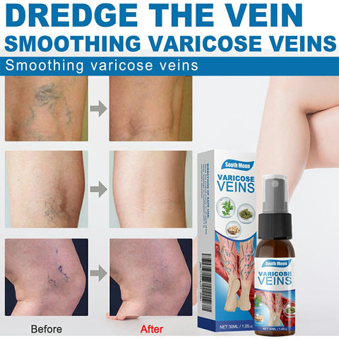 South Moon Varicose Veins Treatment Spray